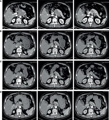 Successful Neoadjuvant Chemotherapy for Small-Cell Neuroendocrine Carcinoma of the Pancreas: A Case Report